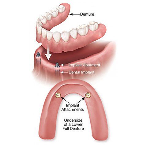 Denture Implant — Burleigh Denture Clinic in Burleigh Heads, QLD