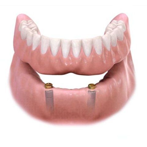 Dental Prosthetist Showing Denture Sample — Burleigh Denture Clinic in Burleigh Heads, QLD