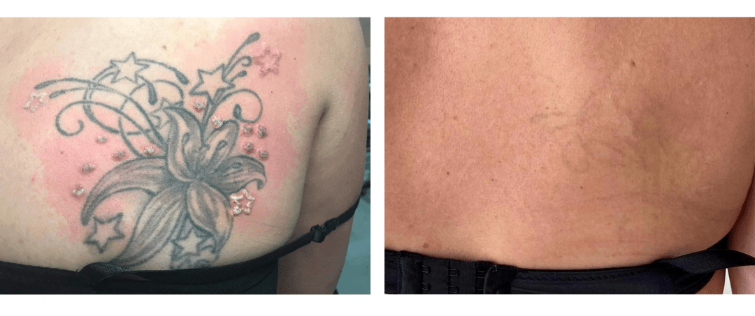 Tattooverwijdering door laser | Rina Skinclinic
