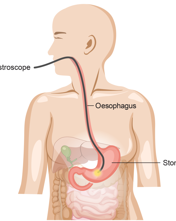 Gastroscopy Procedure Explained 360 Surgery VIC