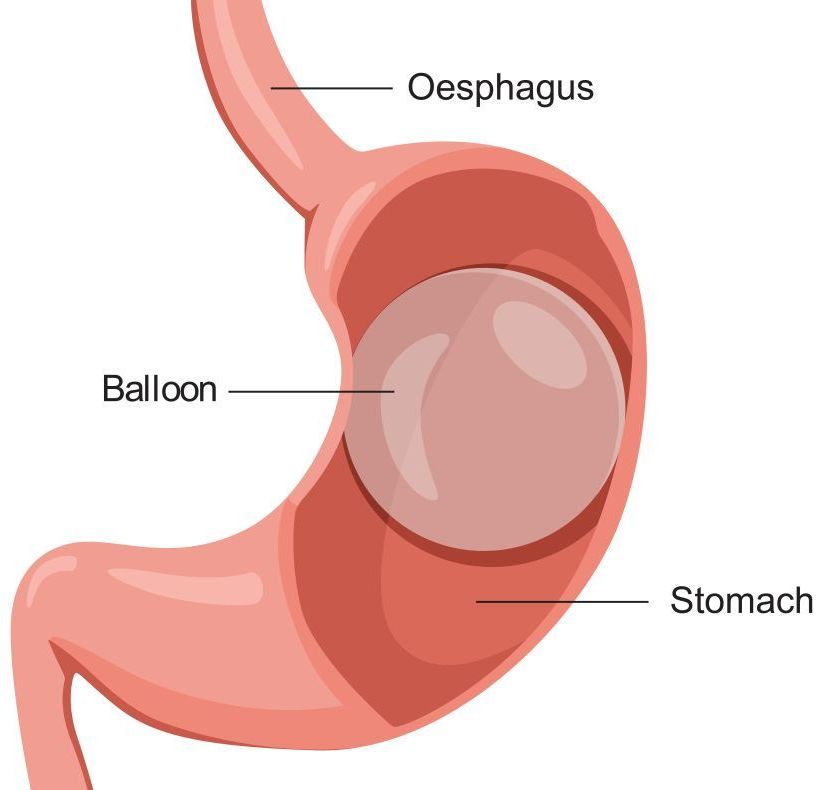 Kidney stone, urinary stone, ureteric stone, renal calculi, renal colic, nephrolithiasis