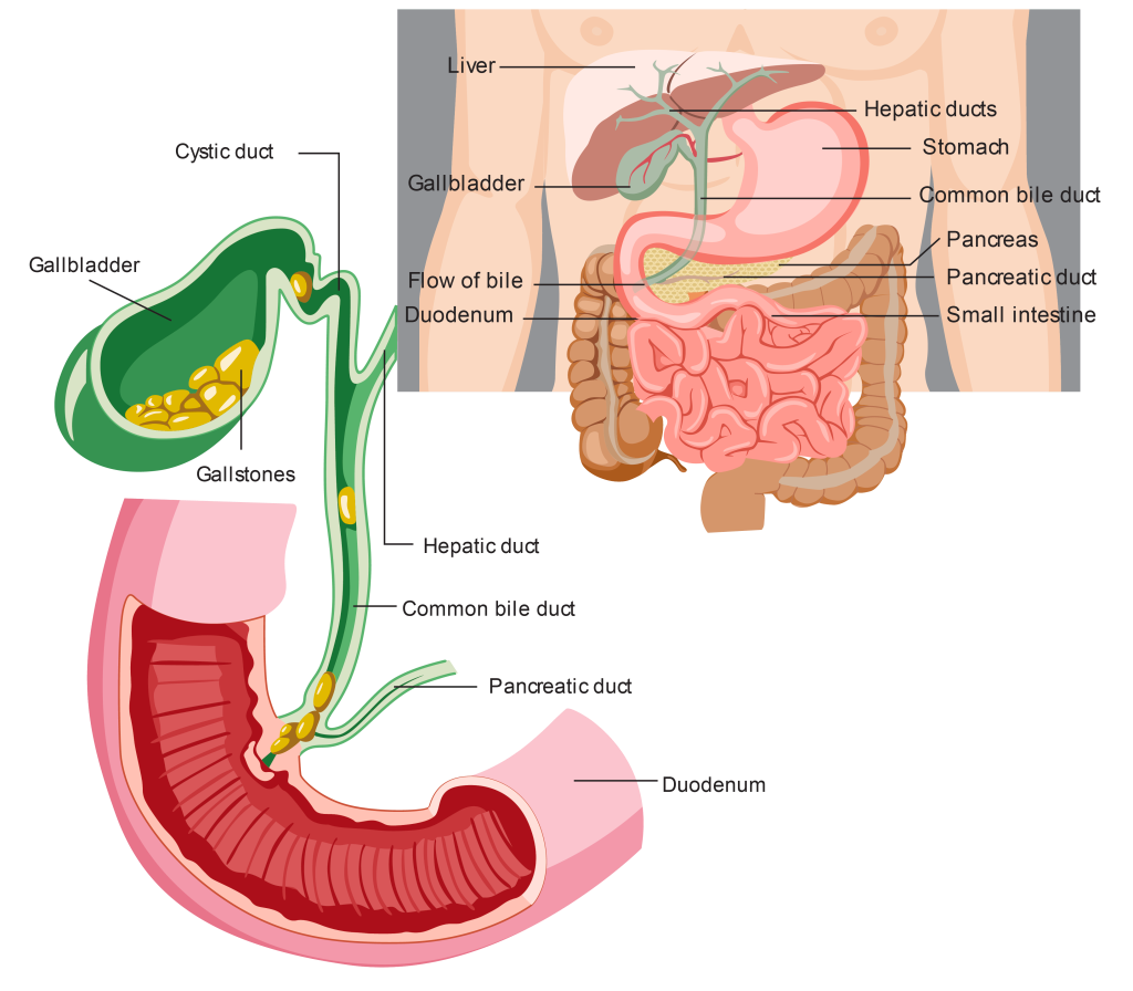 Kidney stone, urinary stone, ureteric stone, renal calculi, renal colic, nephrolithiasis