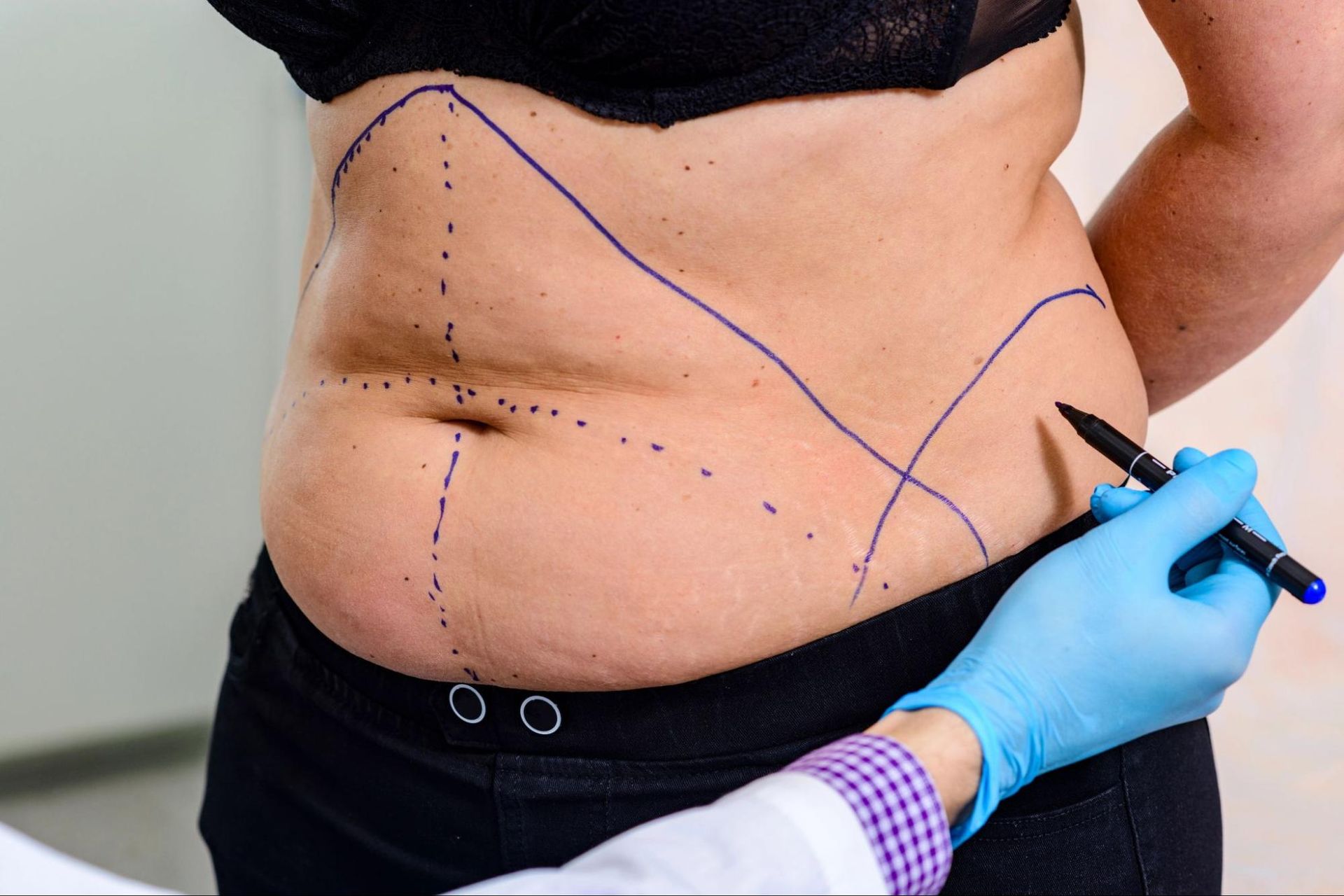 Close-up of a patient's abdomen marked with surgical lines, indicating areas for body contouring