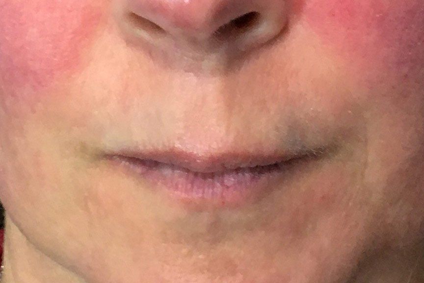 Juvederm Vollure Before Picture at Lush Aesthetics in Georgetown KY
