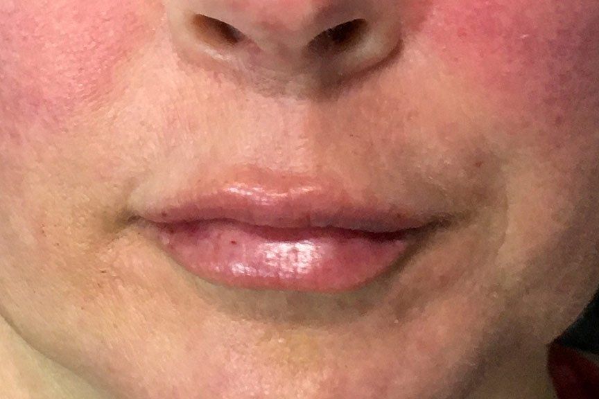 Juvederm Vollure After at Lush Aesthetics in Georgetown KY