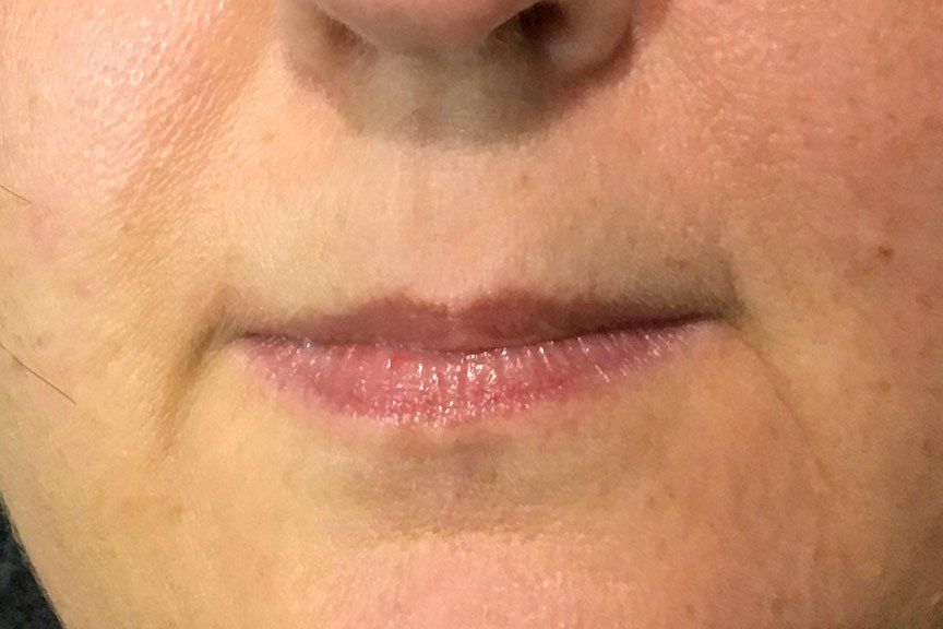 Juvederm Vollure plus Lip Flip Before at Lush Aesthetics in Georgetown KY