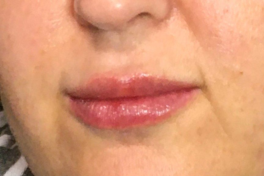 Juvederm Vollure plus Lip Flip After at Lush Aesthetics in Georgetown KY