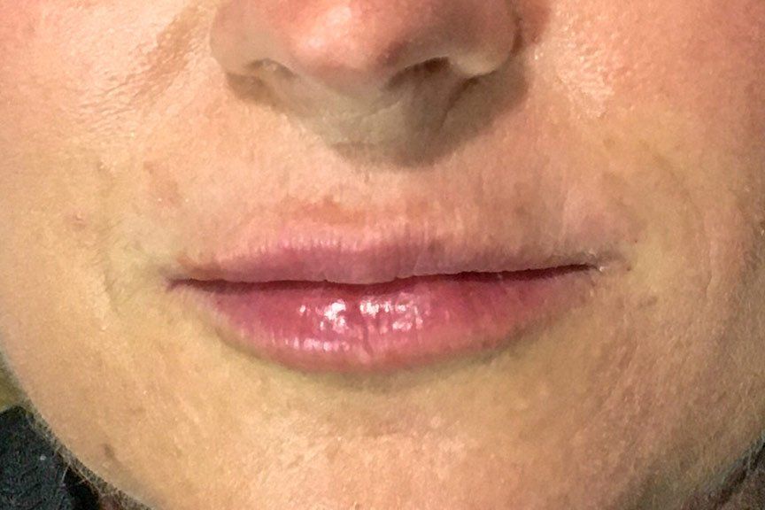 Juvederm Volbella After at Lush Aesthetics in Georgetown KY