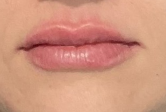 Juvederm Ultra After at Lush Aesthetics in Georgetown KY
