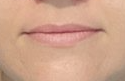 Juvederm Ultra Before at Lush Aesthetics in Georgetown KY