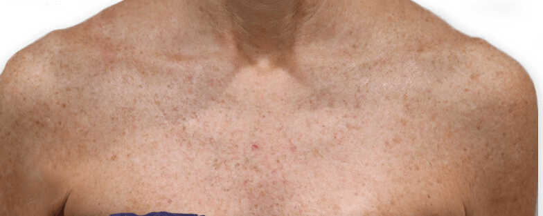 VI Body Chemical Peel After Picture