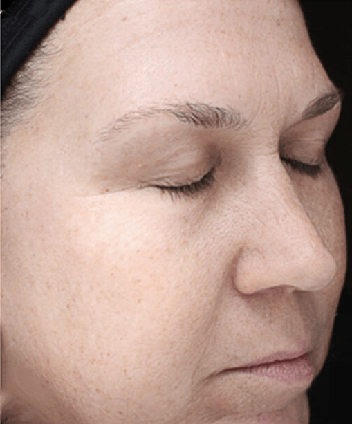 VI Advance Chemical Peel After Picture