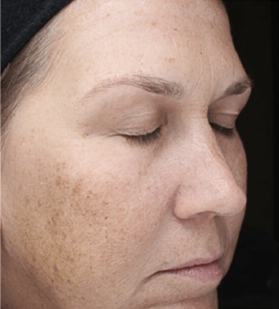 VI Advance Chemical Peel before Picture