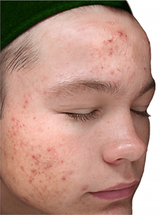 VI Purify Chemical Peel Before Picture