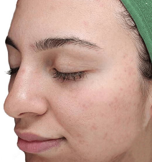 VI Purify Chemical Peel After Picture