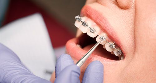 Ortodoncia, beneficios de la ortodoncia