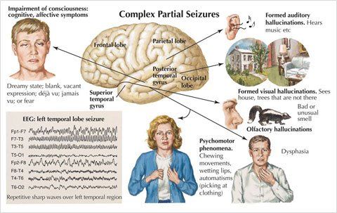 chart showing complex partial seizures