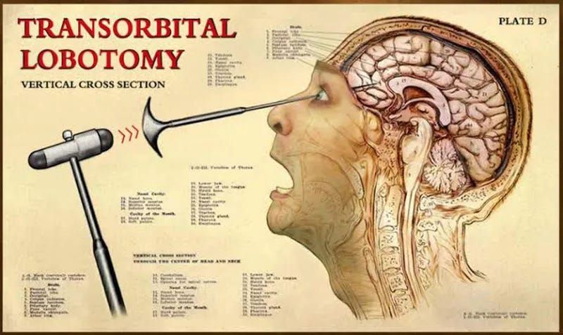 frontal lobotomy