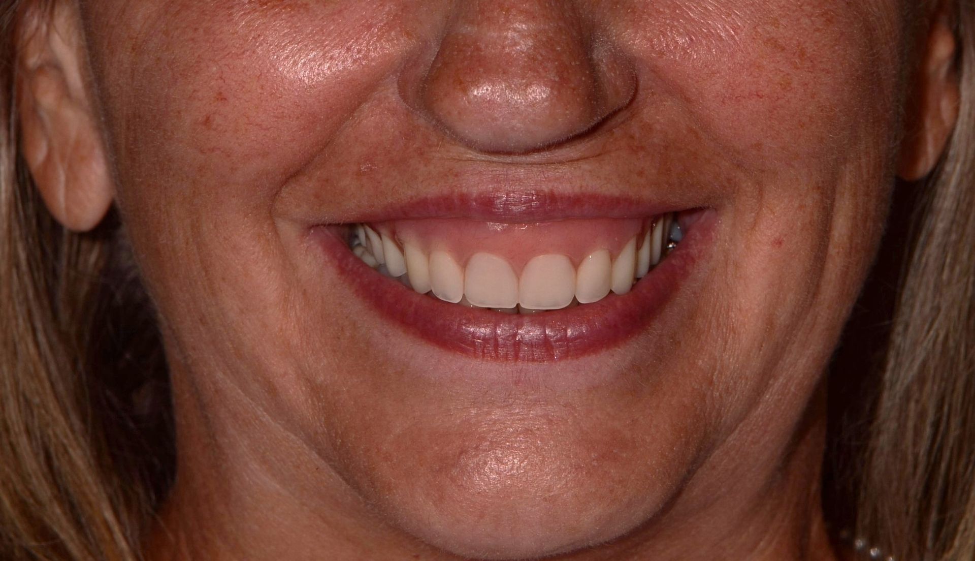 A close up of a woman 's smile with white teeth.