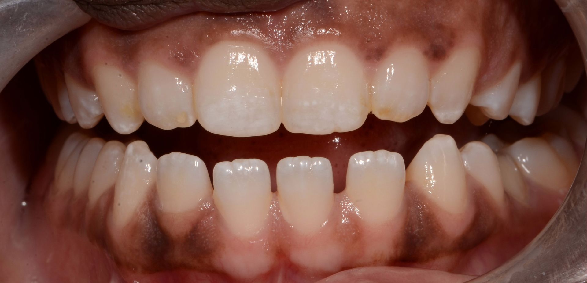 A close up of a person 's teeth with a mouth guard.