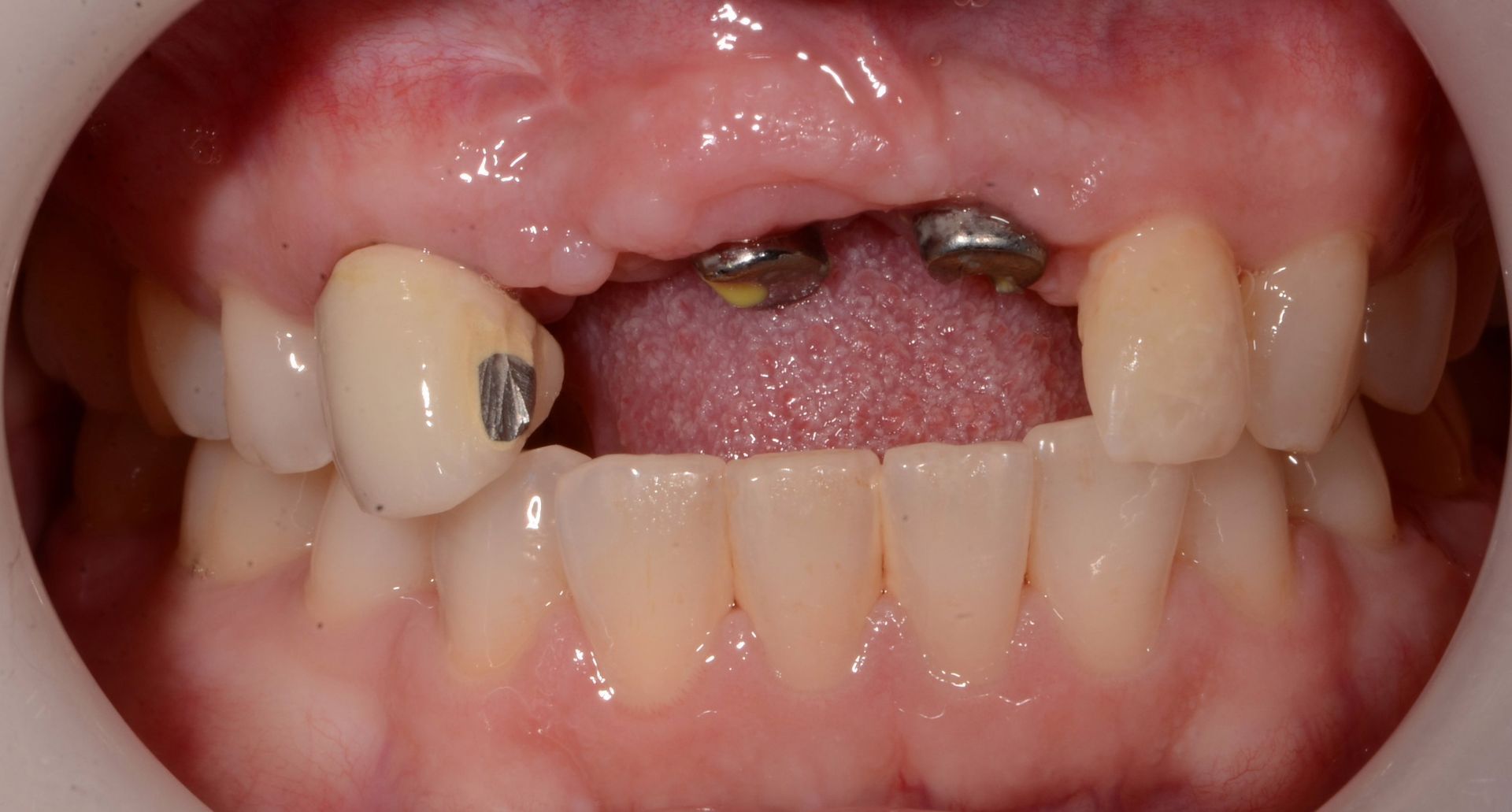 A close up of a person 's mouth with missing teeth.