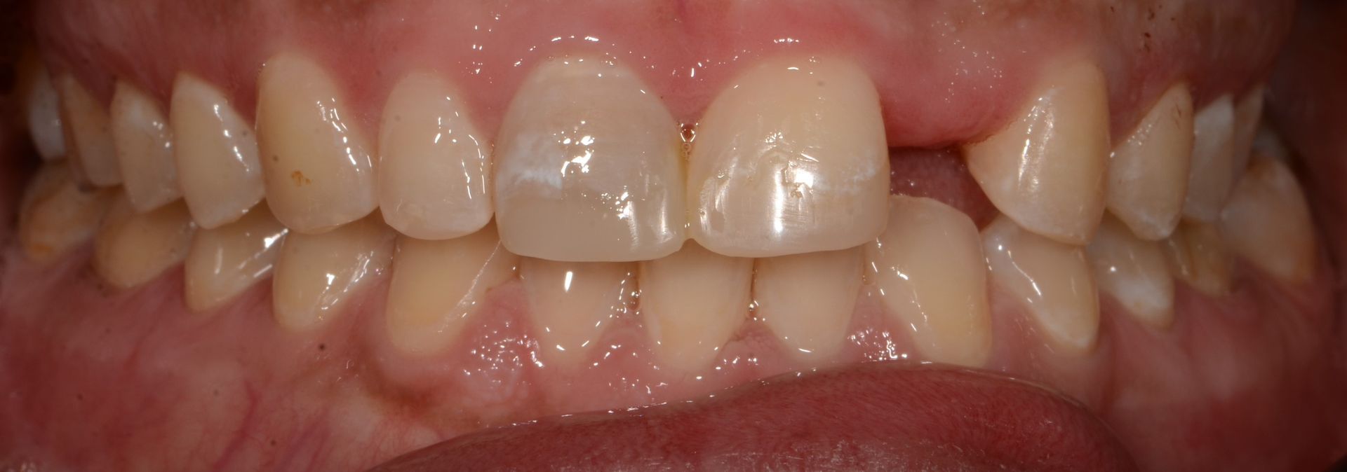 A close up of a person 's teeth and mouth.
