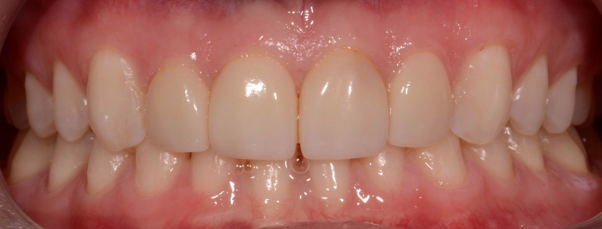 A close up of a person 's teeth with white teeth.