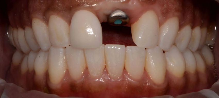 A close up of a person 's teeth with a dental implant in the middle.