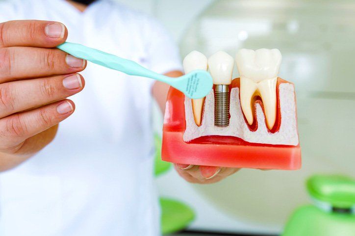 dentist holding dental implants model
