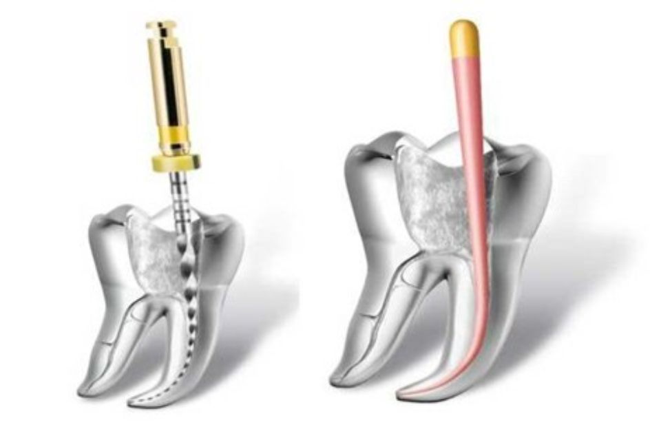 Endodonzia