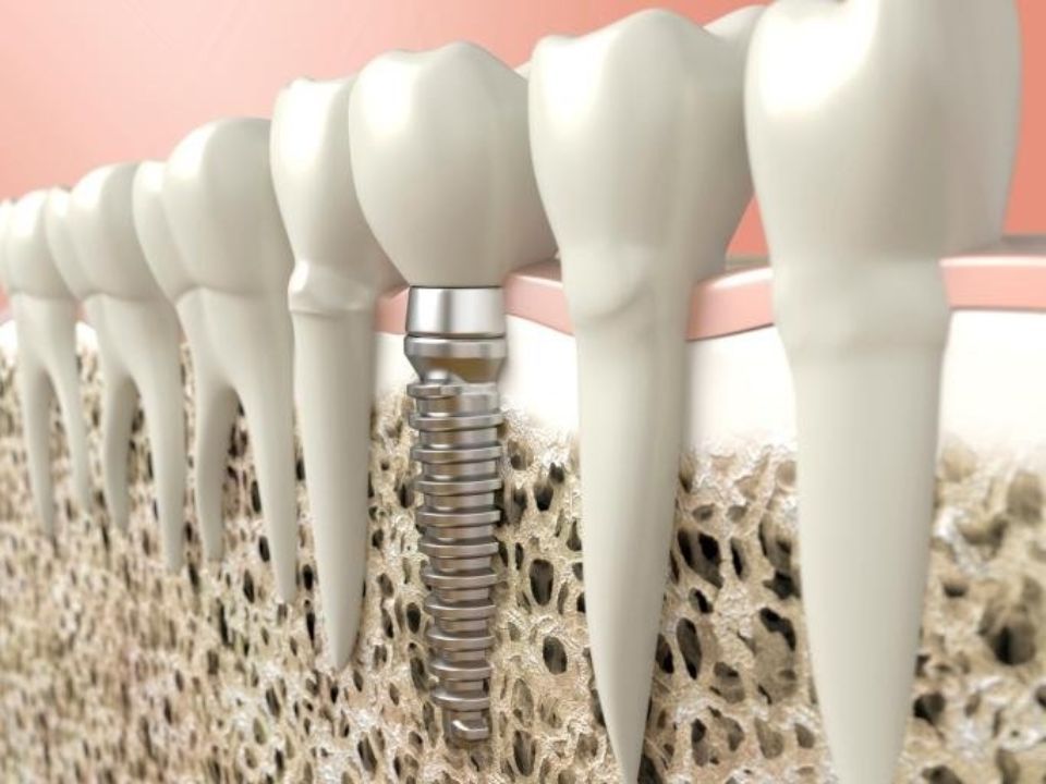 Trapani da dentista