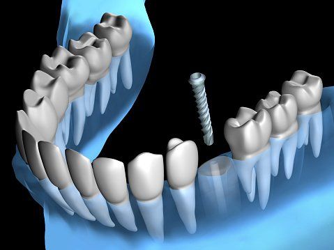 Introduzione protesi