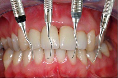Particolare trapani del dentista