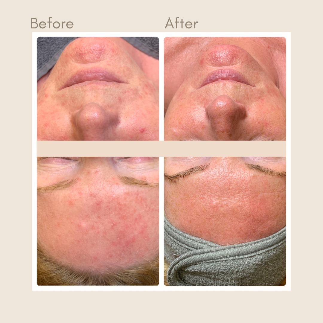 Producten voor acne