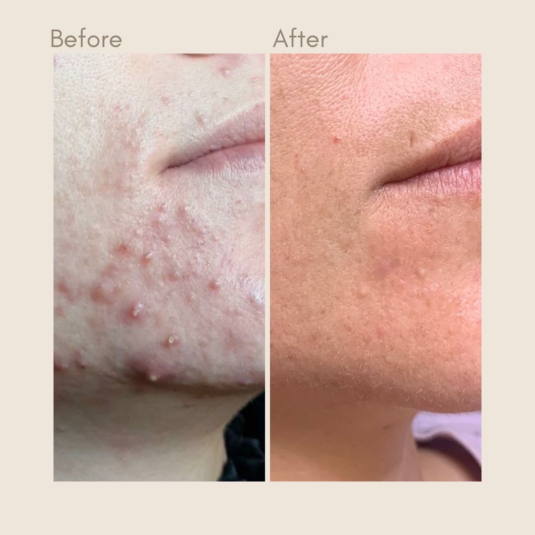 Producten voor acne