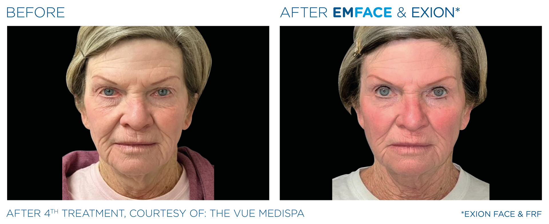 A before and after photo of a woman 's face.