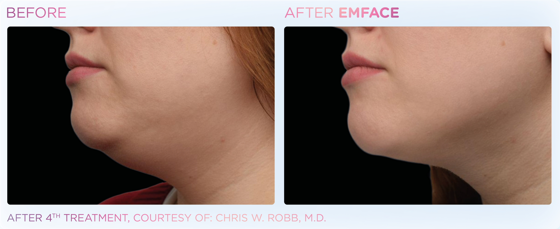 A before and after photo of a woman 's neck and chin.
