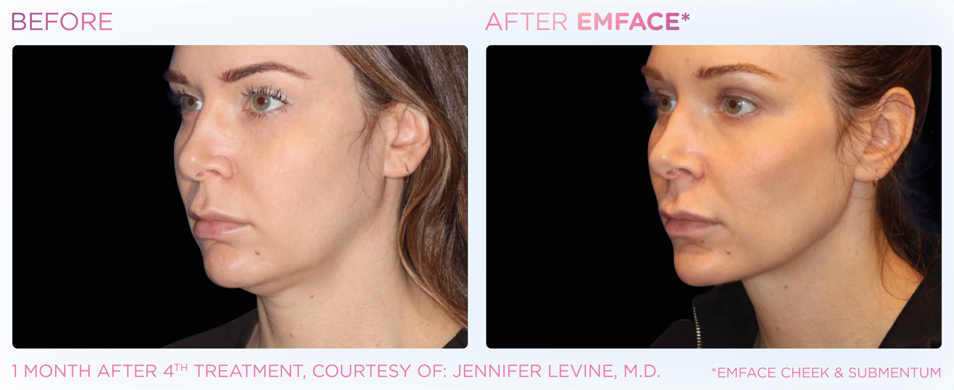 A before and after photo of a woman 's face.