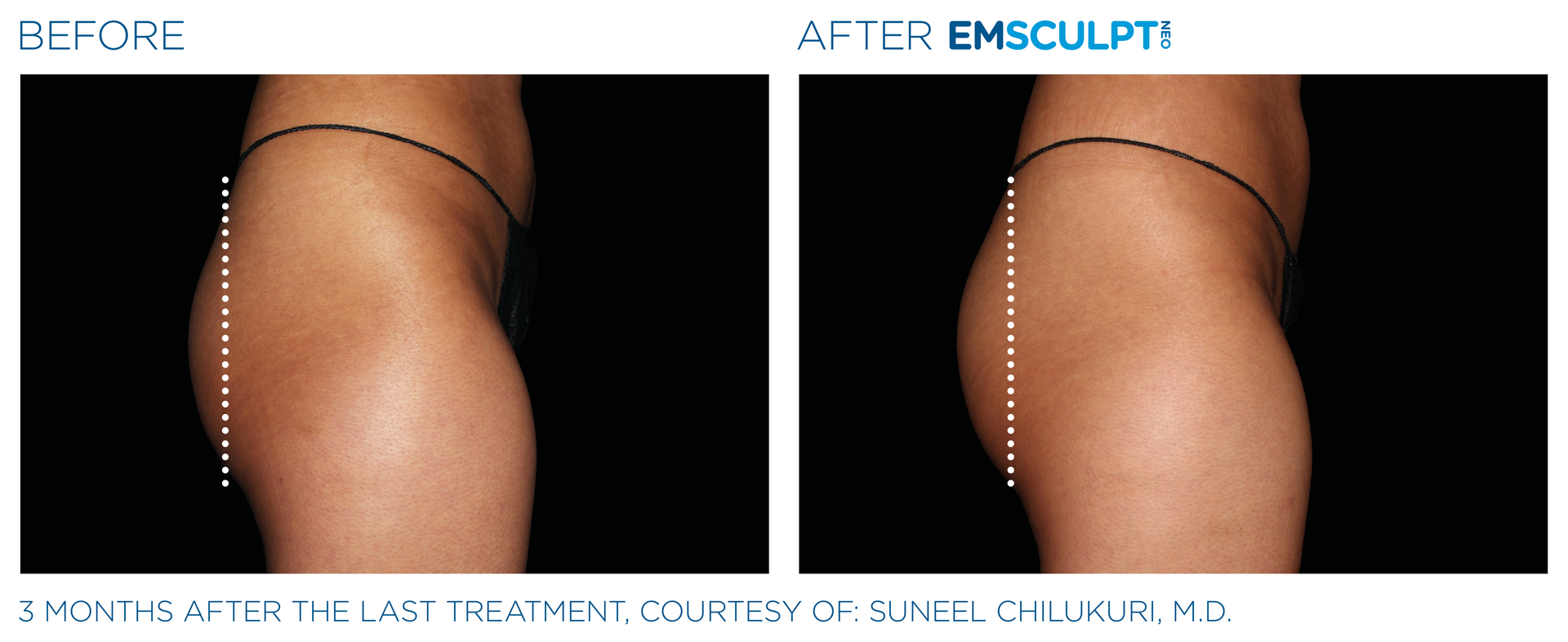 Emsculpt_Neo results
