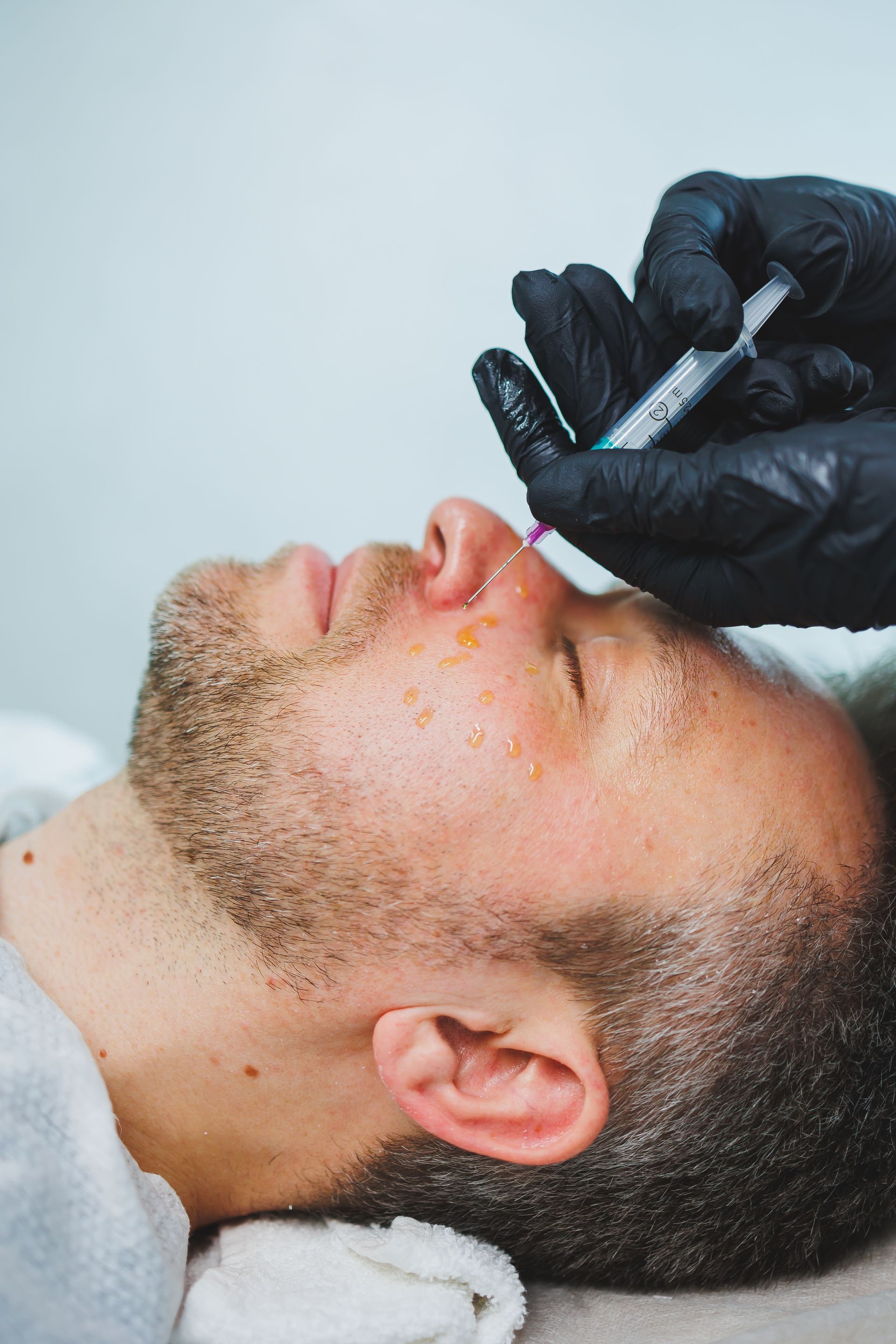 Person receiving facial injection; gloved hand holding syringe near nose, lying down on a medical table.