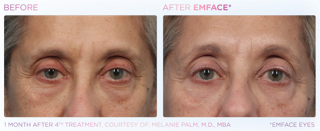 A before and after photo of a woman 's eyes.