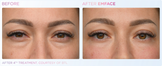 A before and after photo of a woman 's eyes.