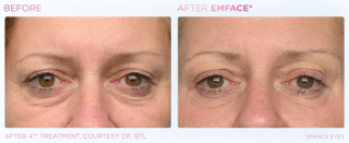 A before and after photo of a woman 's eyes.