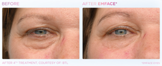 A before and after photo of a woman 's eyes.