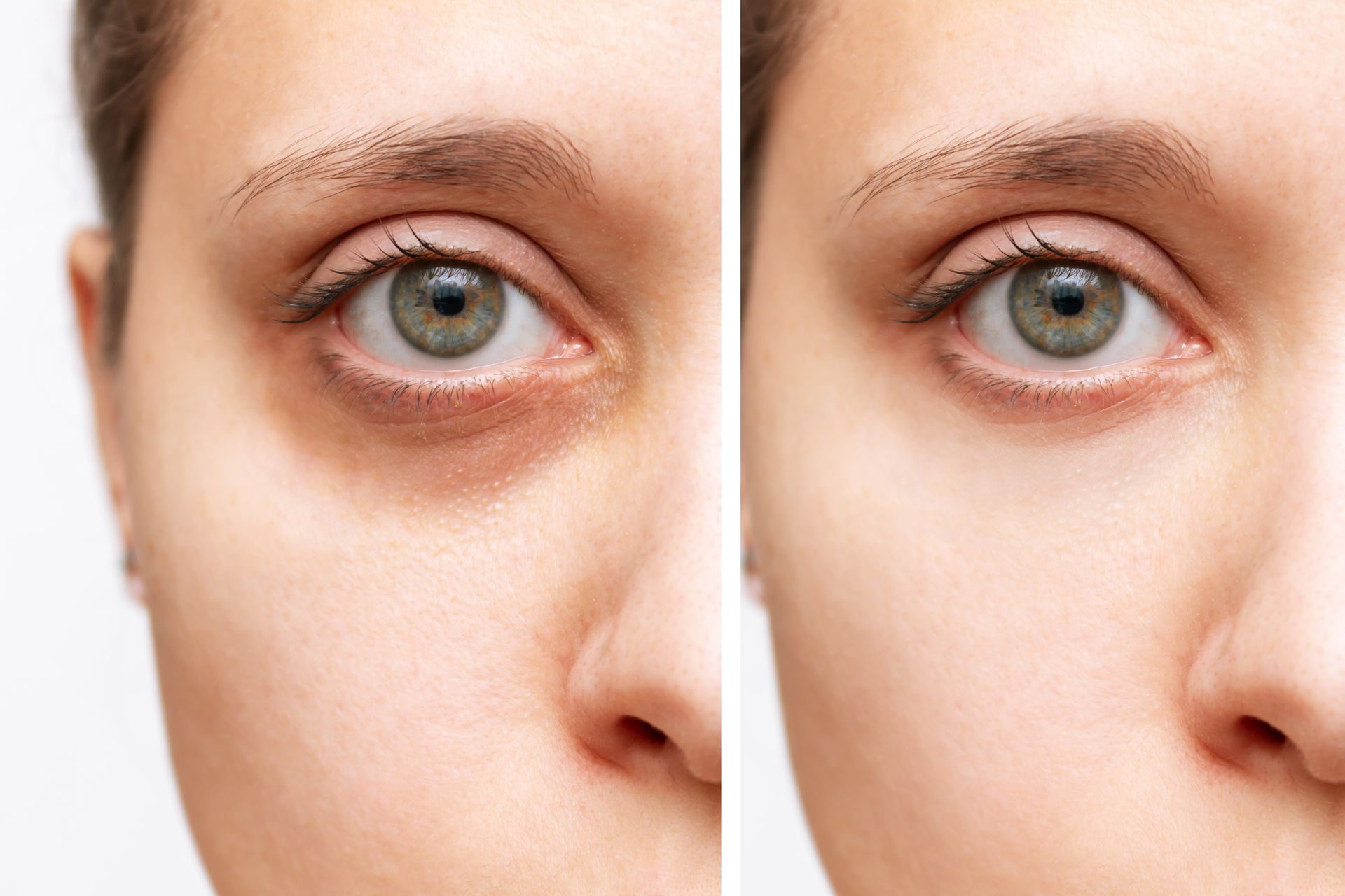 Side-by-side comparison of a person's eyes, showing dark circles under one eye and their absence in the other.