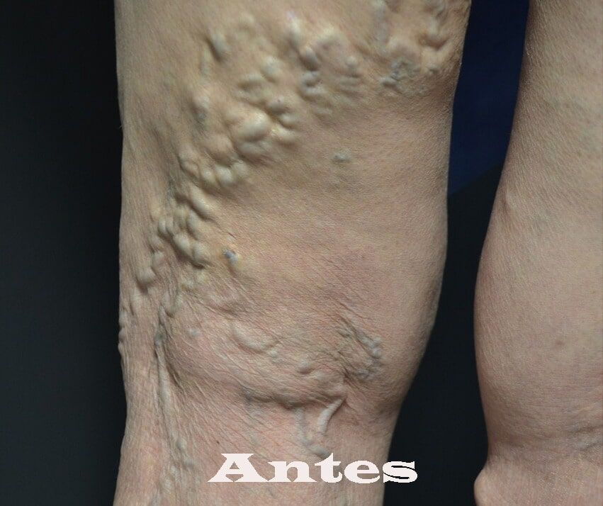 Médica Integral del Pie - várices antes