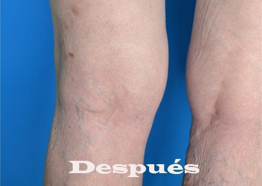 Médica Integral del Pie - várices después

