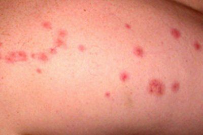 hand after bed bugs biting