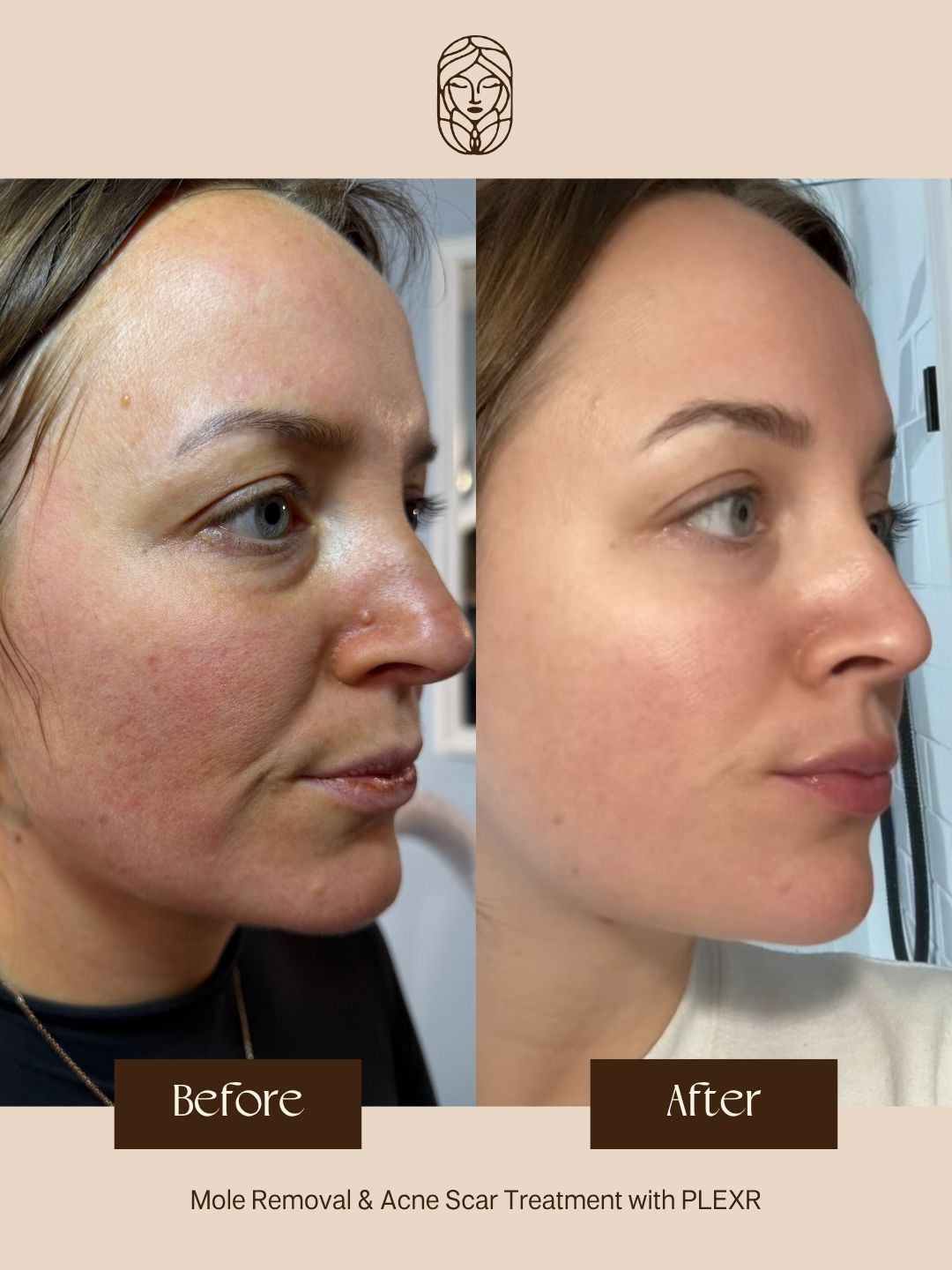 Before and after comparison of a facial skin treatment for mole removal and acne scarring using PLEXR.