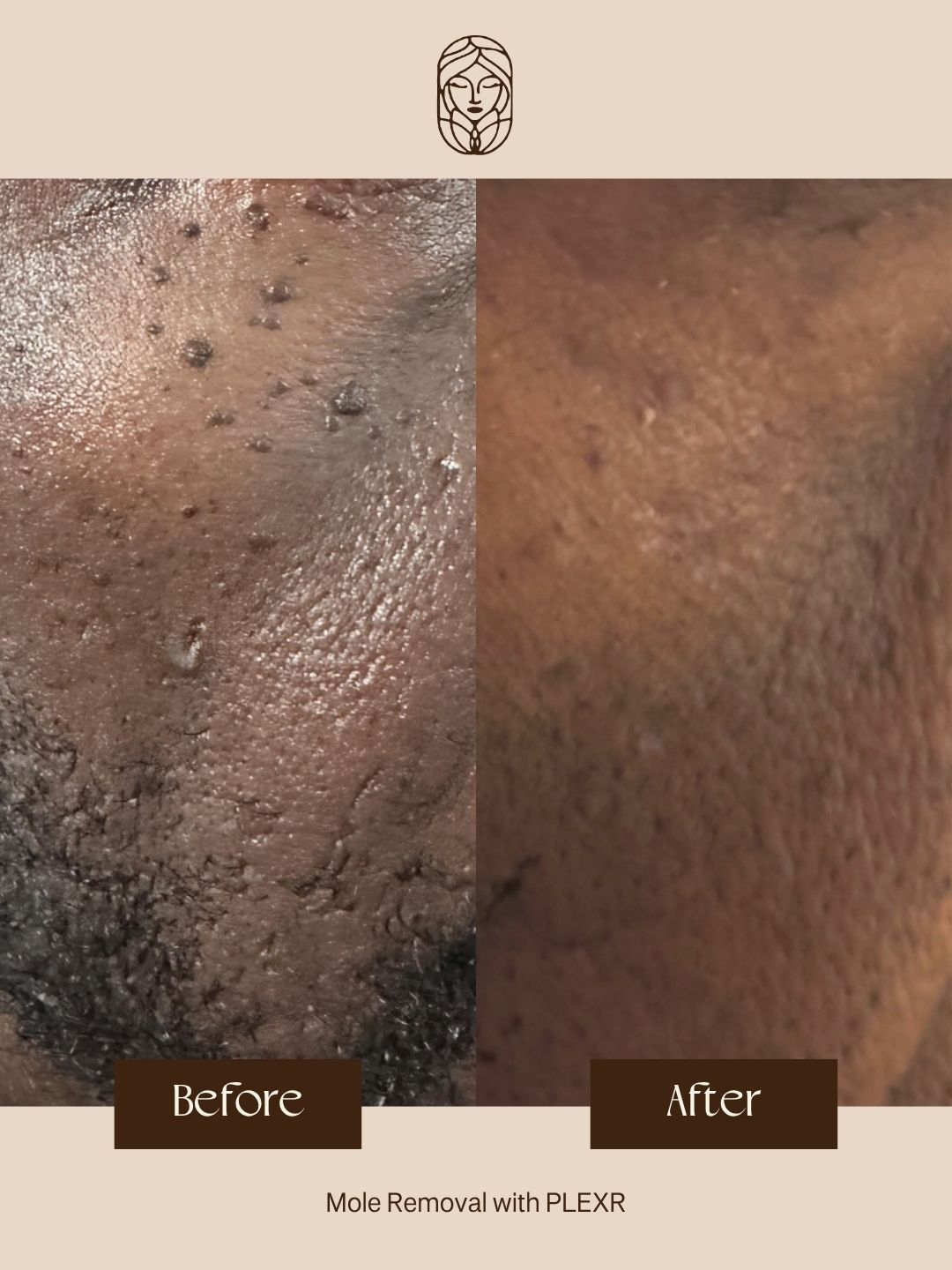 Before-and-after comparison of skin with raised bumps removed, labeled 